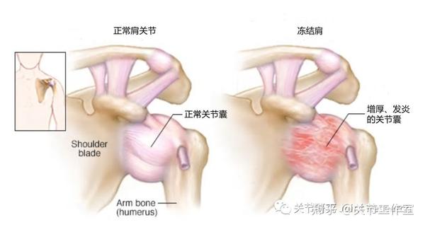 冻结肩 大概就是你说的 肩周炎 知乎