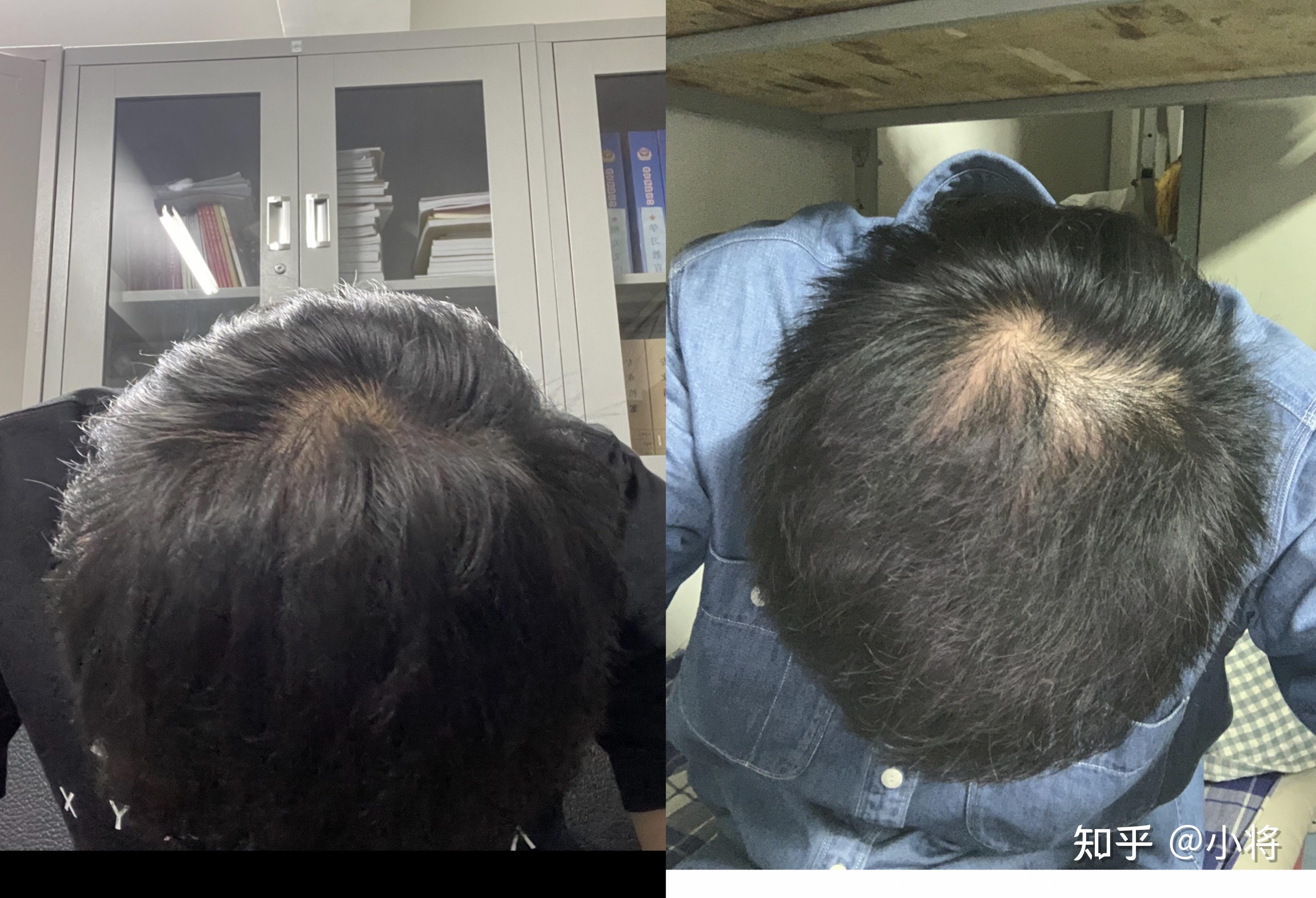 服用非那雄胺片半年的对比 - 知乎