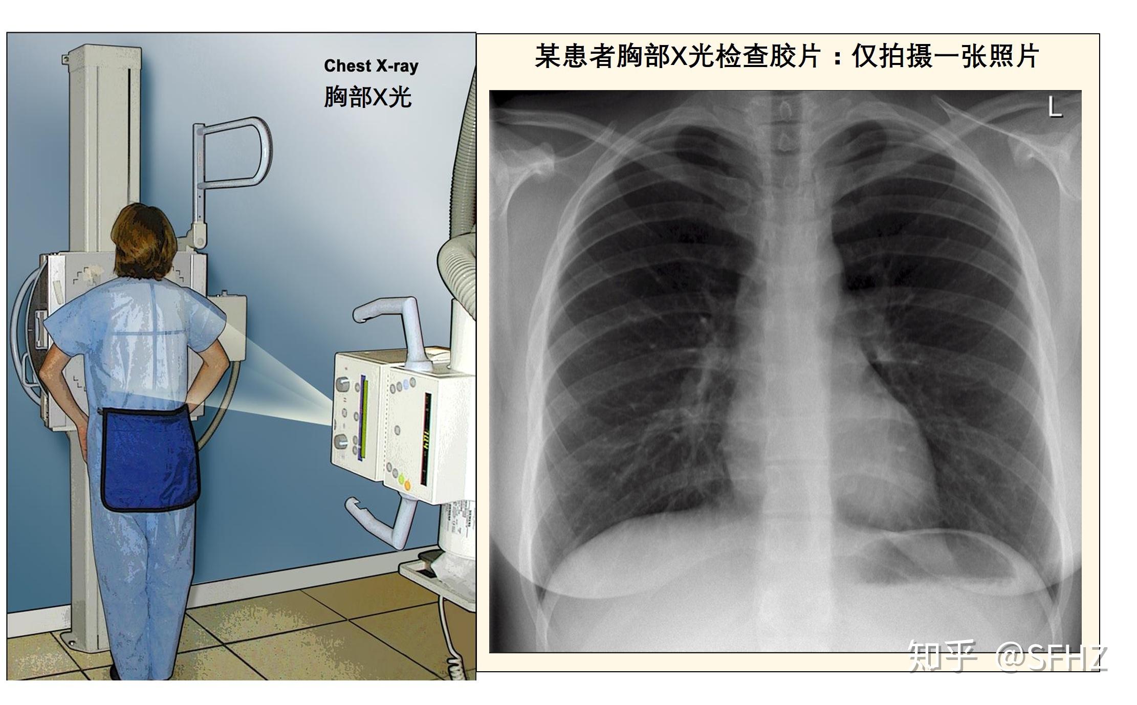 图2—47 肺泡癌-胸部X线影像学图鉴-医学