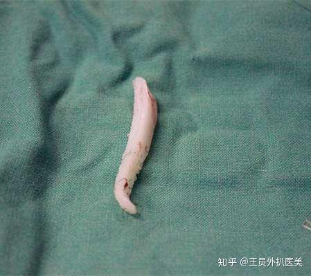 膨体隆鼻和硅胶假体隆鼻哪个好为什么说膨体隆鼻更危险