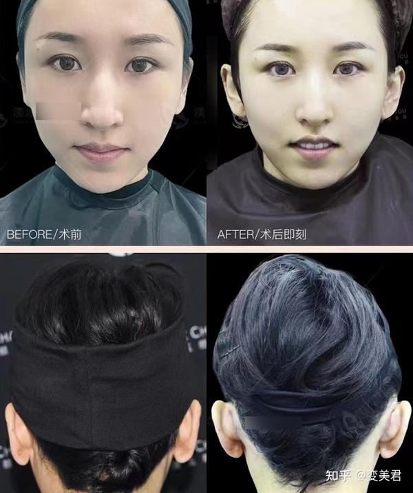 网红们开始另辟蹊径给耳朵做整形了 知乎