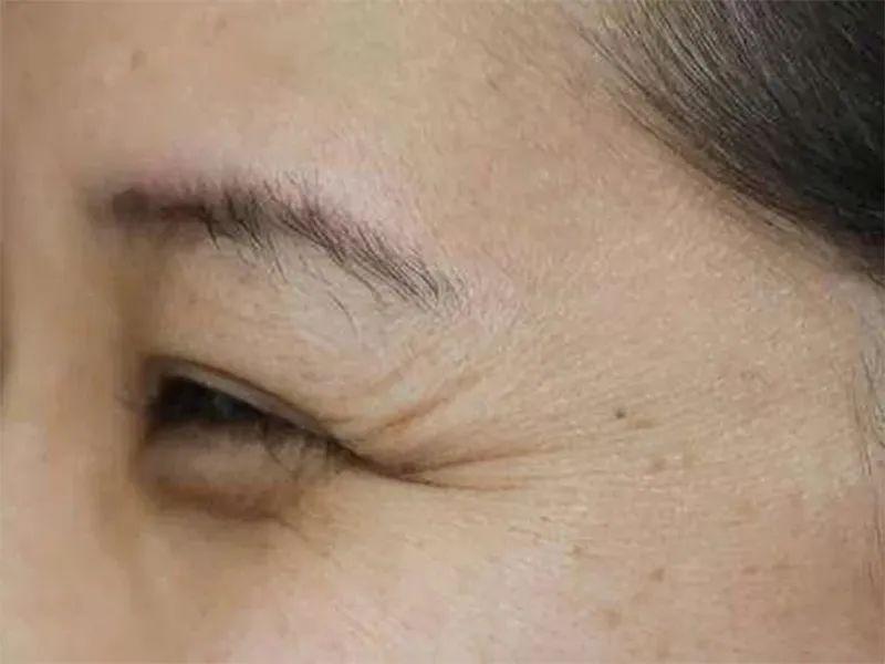 鱼尾纹——怎么有效去除鱼尾纹,摆脱年轻敌人?