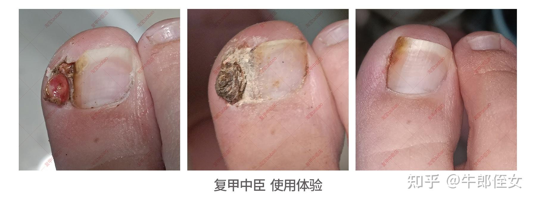 甲沟炎之后已经特别肿了怎么处理,要先剪指甲吗 - 知乎