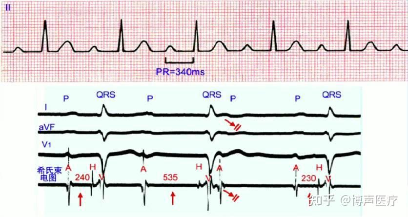 传导阻滞心电图特点图片