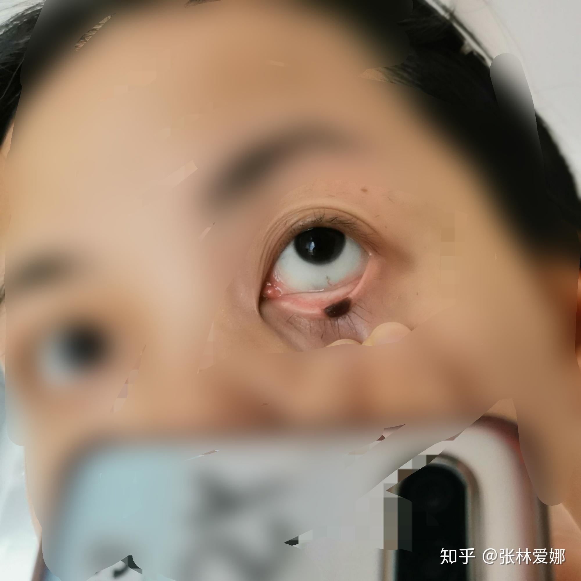 眼睑痣切除 - 知乎