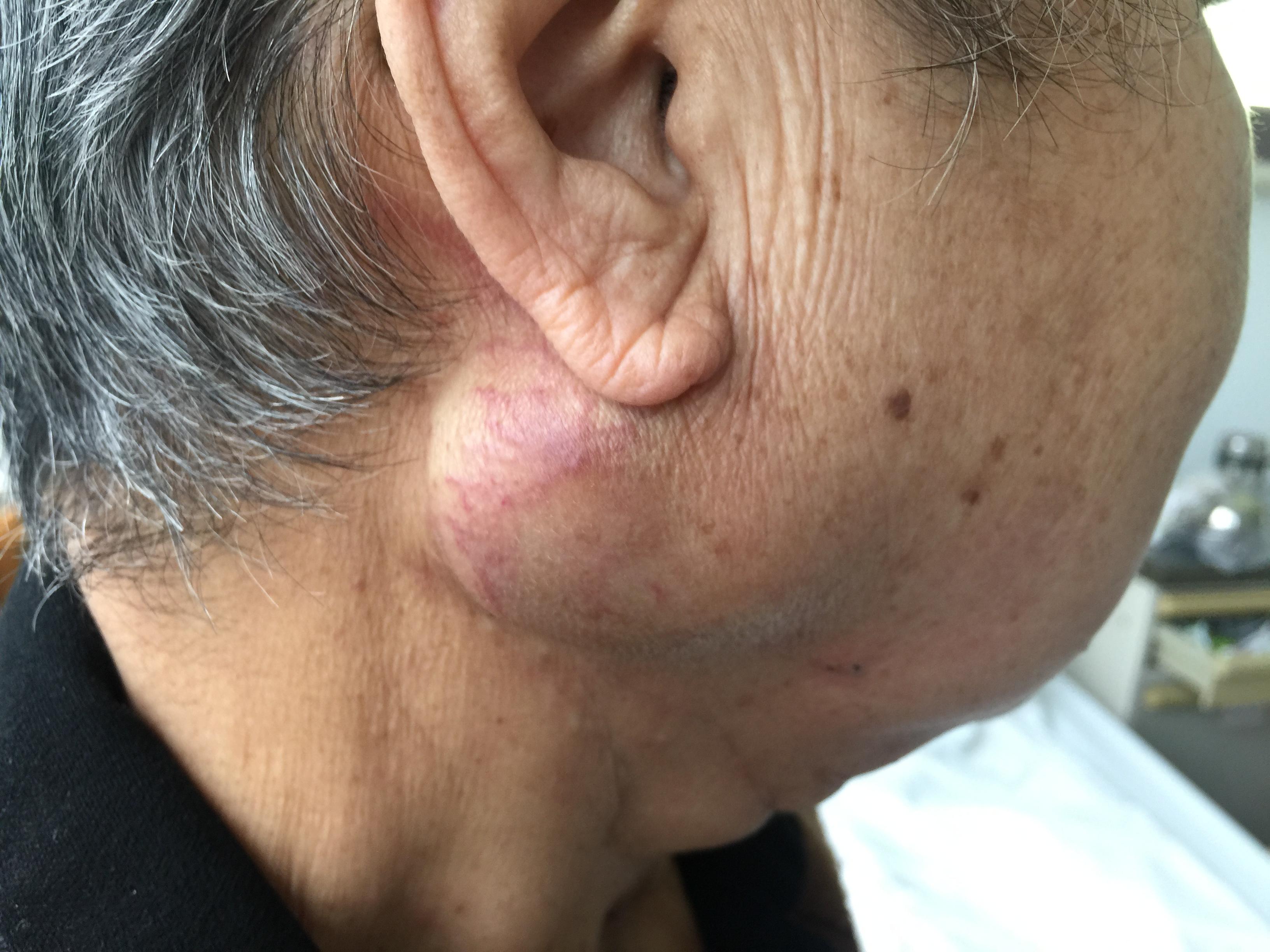 上图颈部ct可以看到颈部及腋下淋巴结多发转移