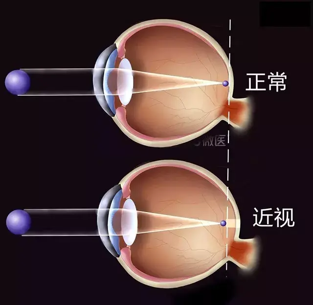 近視和散光多少度才可以做近視手術?