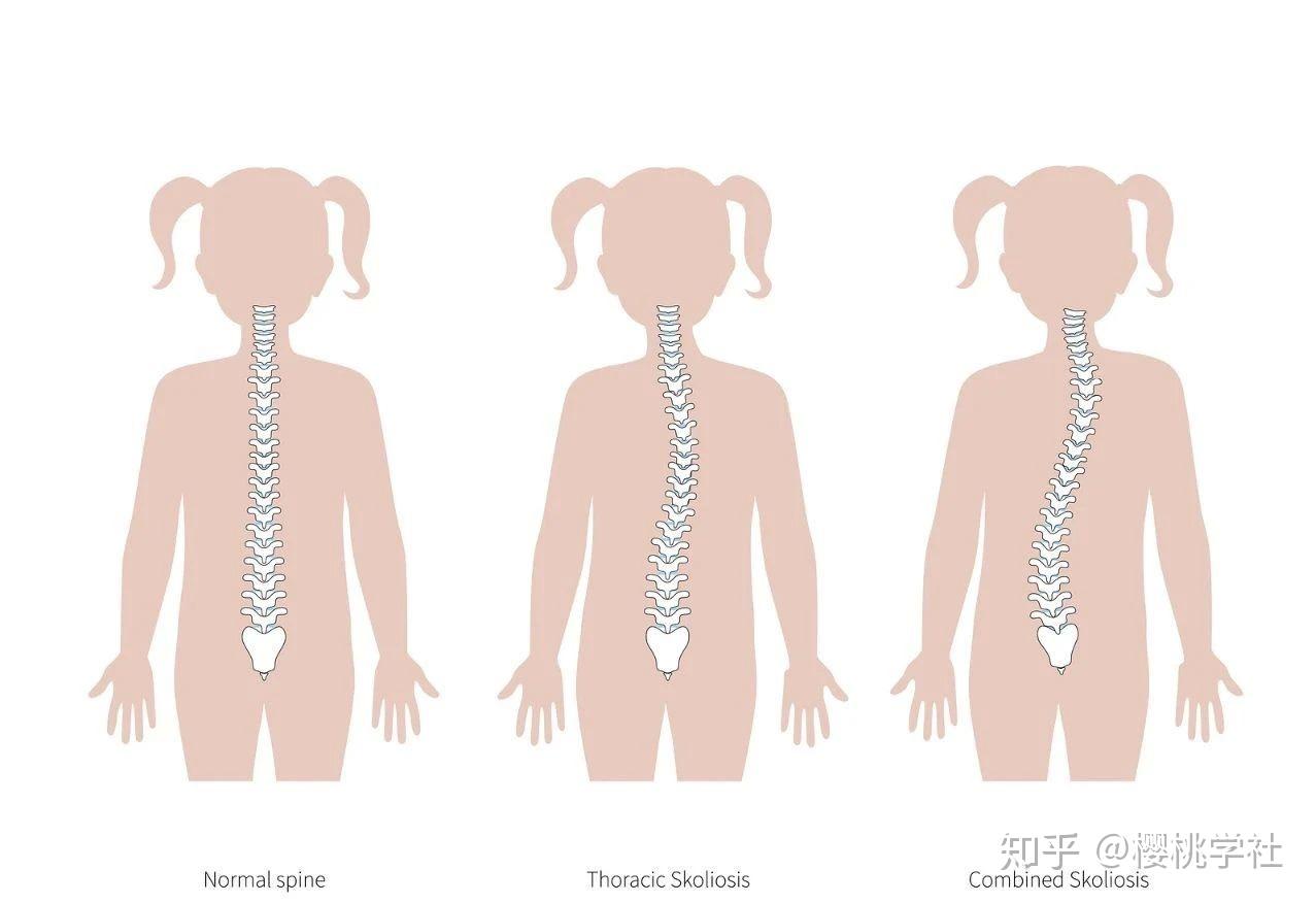 小孩驼背图片 严重图片