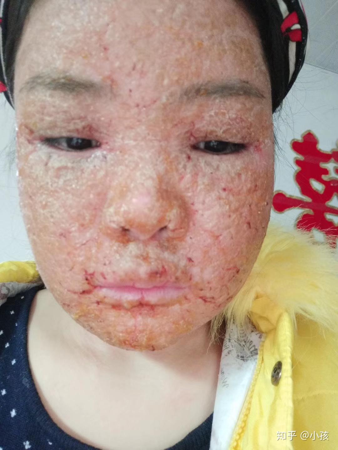 激素脸该怎么处理?