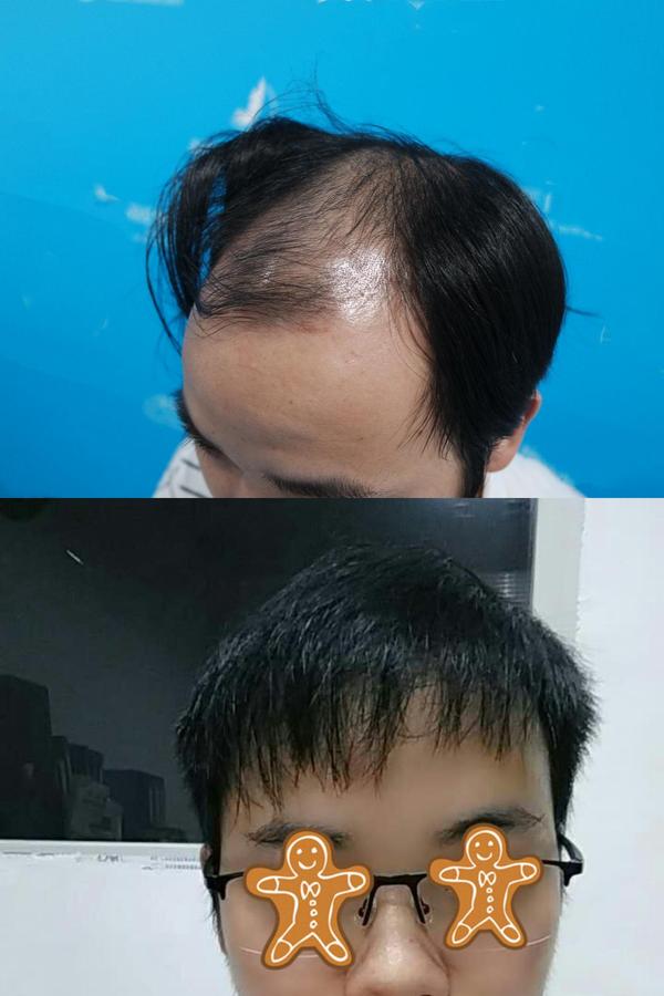 后期的雄性激素脱发处于4-7级的严重雄脱患者,由于初期没有发现脱发