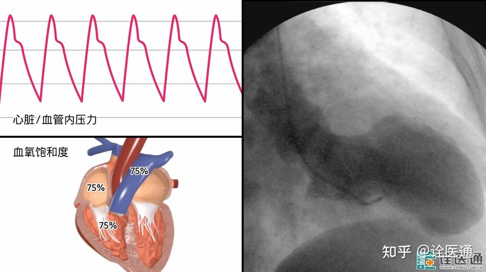和你聊聊心导管检查那些事