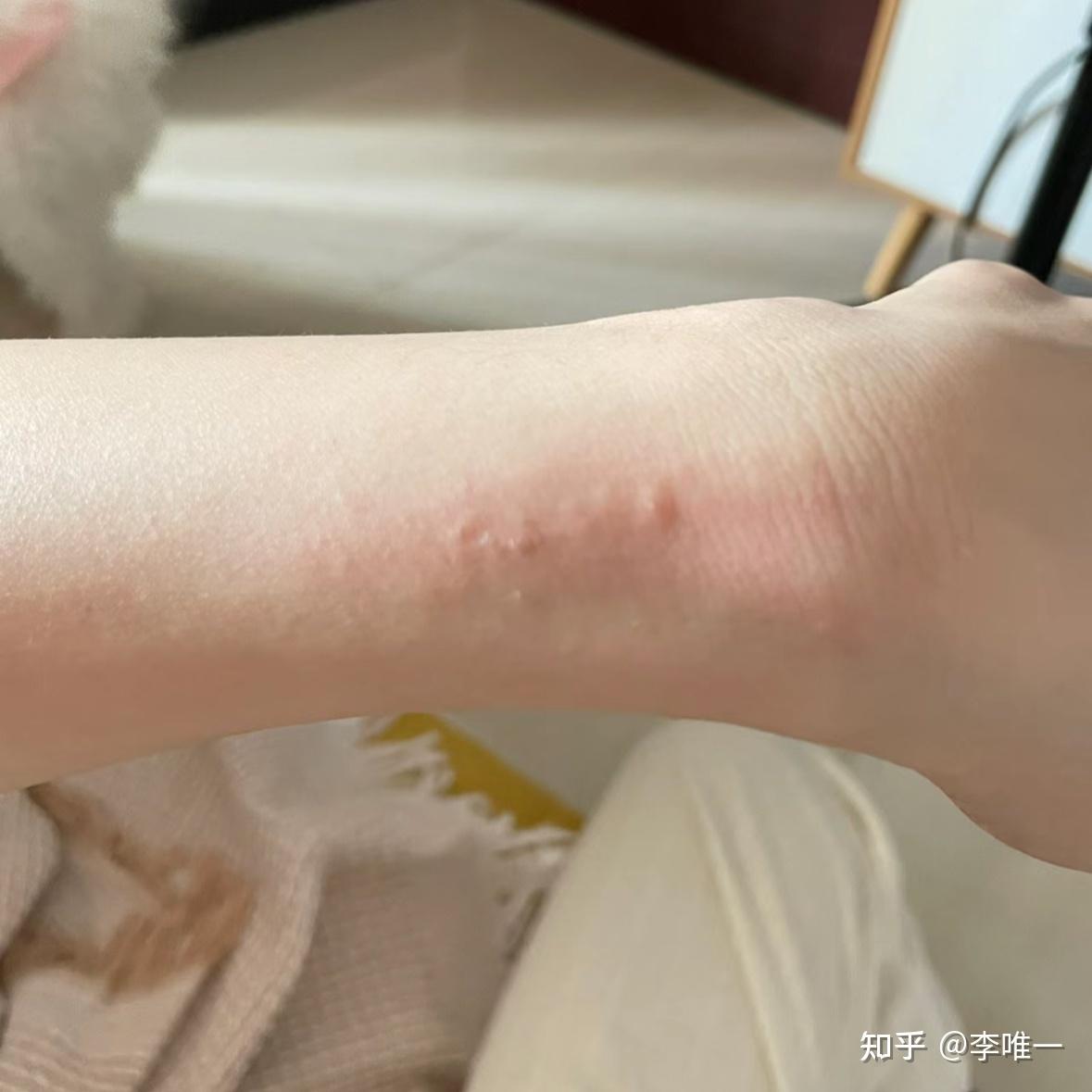 1,过敏性皮炎对于敏感人群而言,螨虫会直接导致皮肤过敏问题.