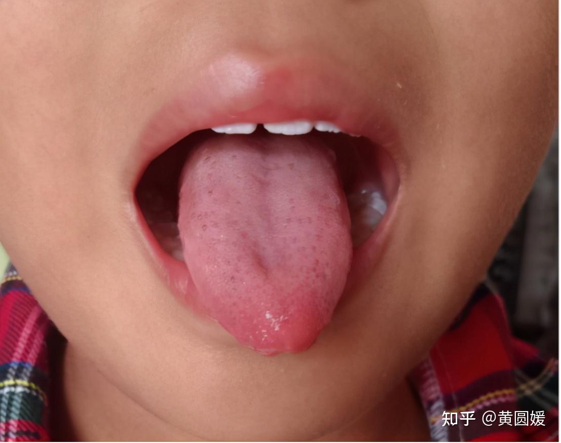 小患者的舌质红,舌苔厚,有草莓点,舌面水滑,属气阴两虚,脾胃湿热之症