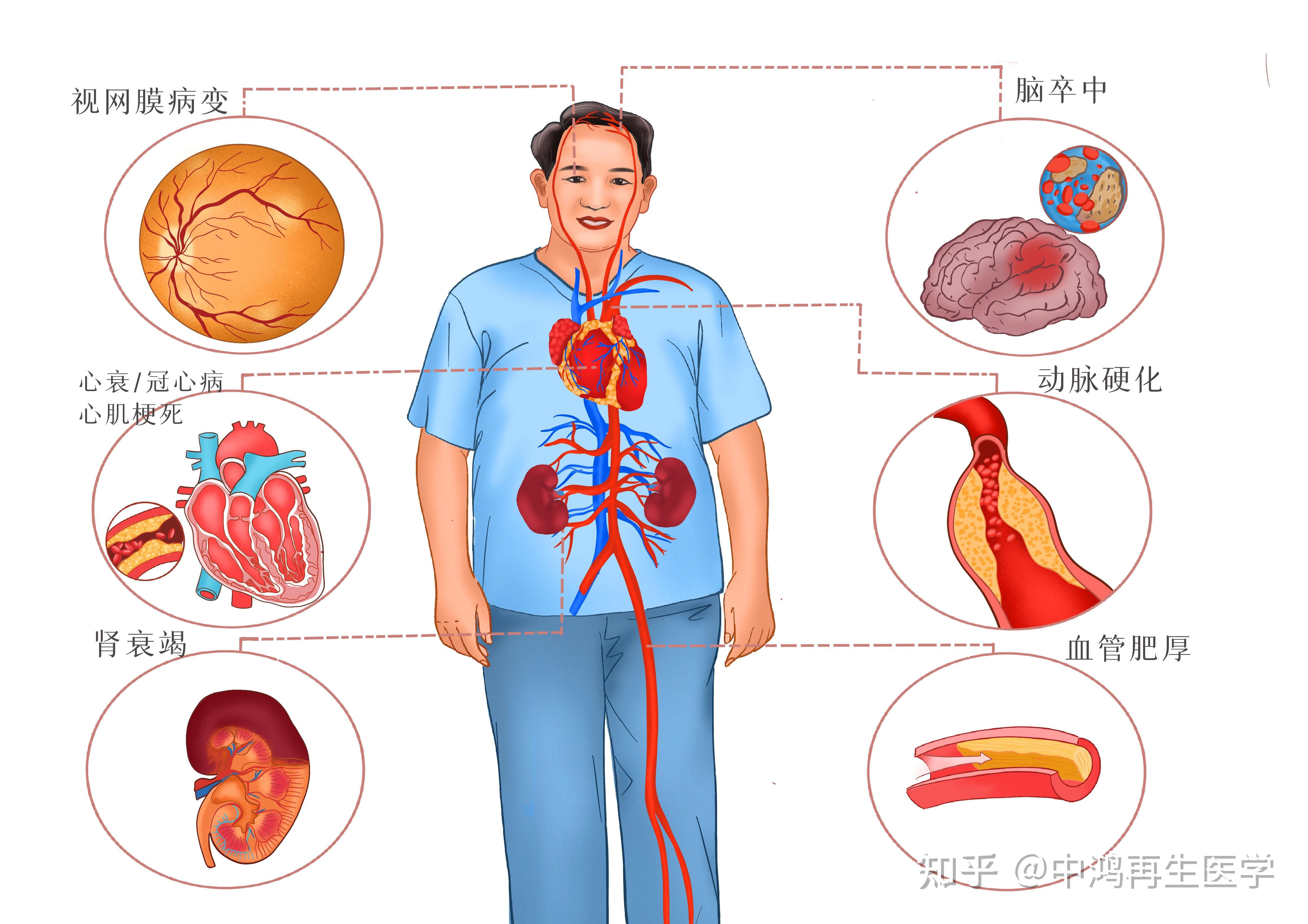 不肥胖的人高血压患病可能性是15,而肥胖者高血压患病可能性高达40.