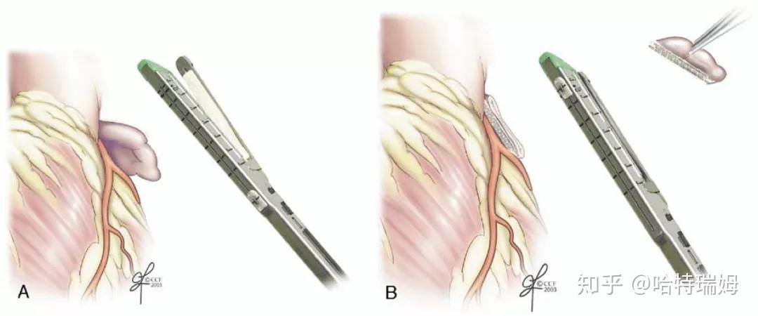 stapled excision of the left atrial appendage.