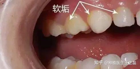 牙结石和牙垢的区别图片