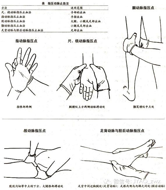 运动防护必会的止血急救法 知乎