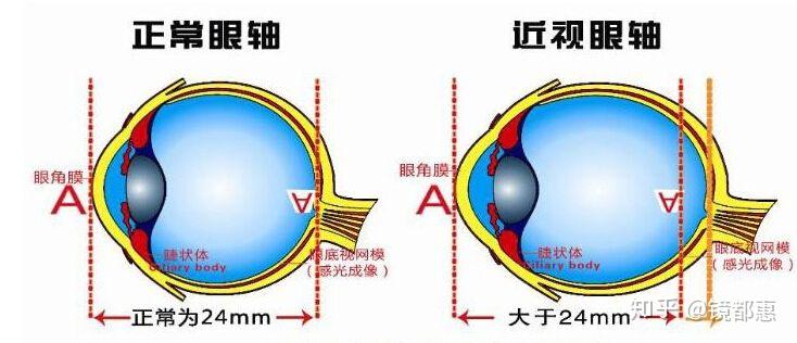 配镜轴位75什么意思,眼镜轴位177是什么意思
