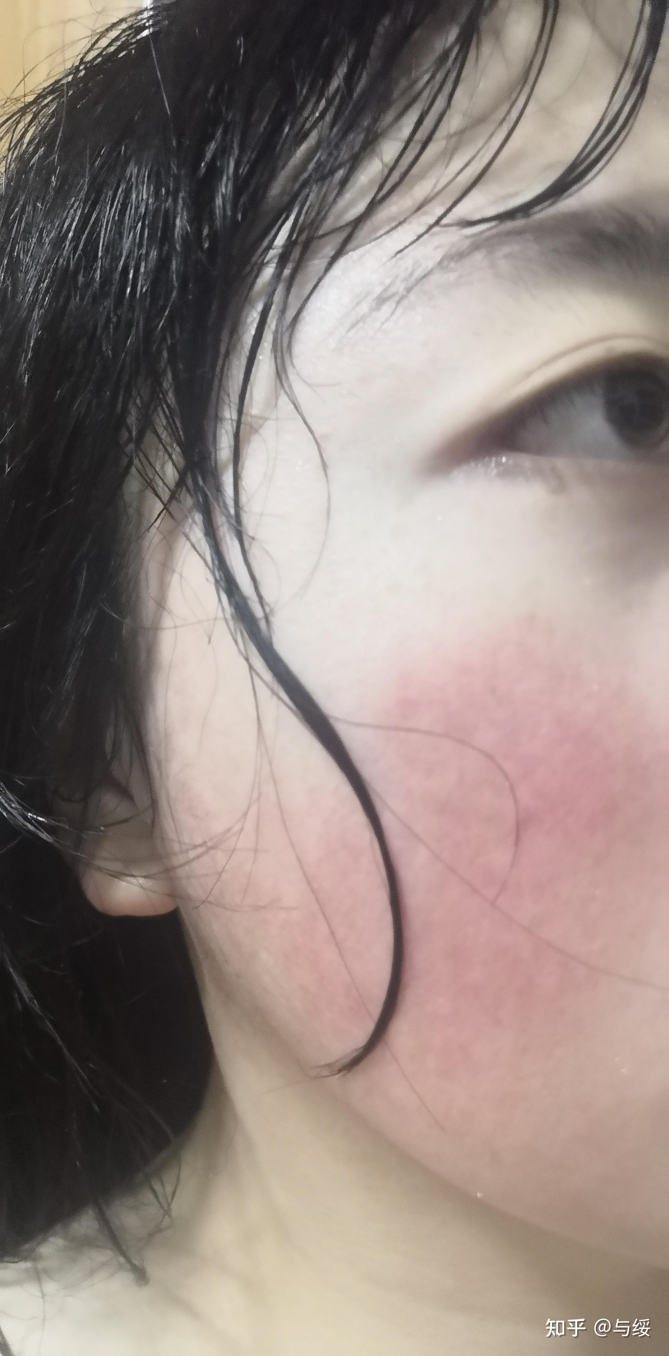 光子嫩肤经验贴 (主要目的:去红血丝) - 知乎