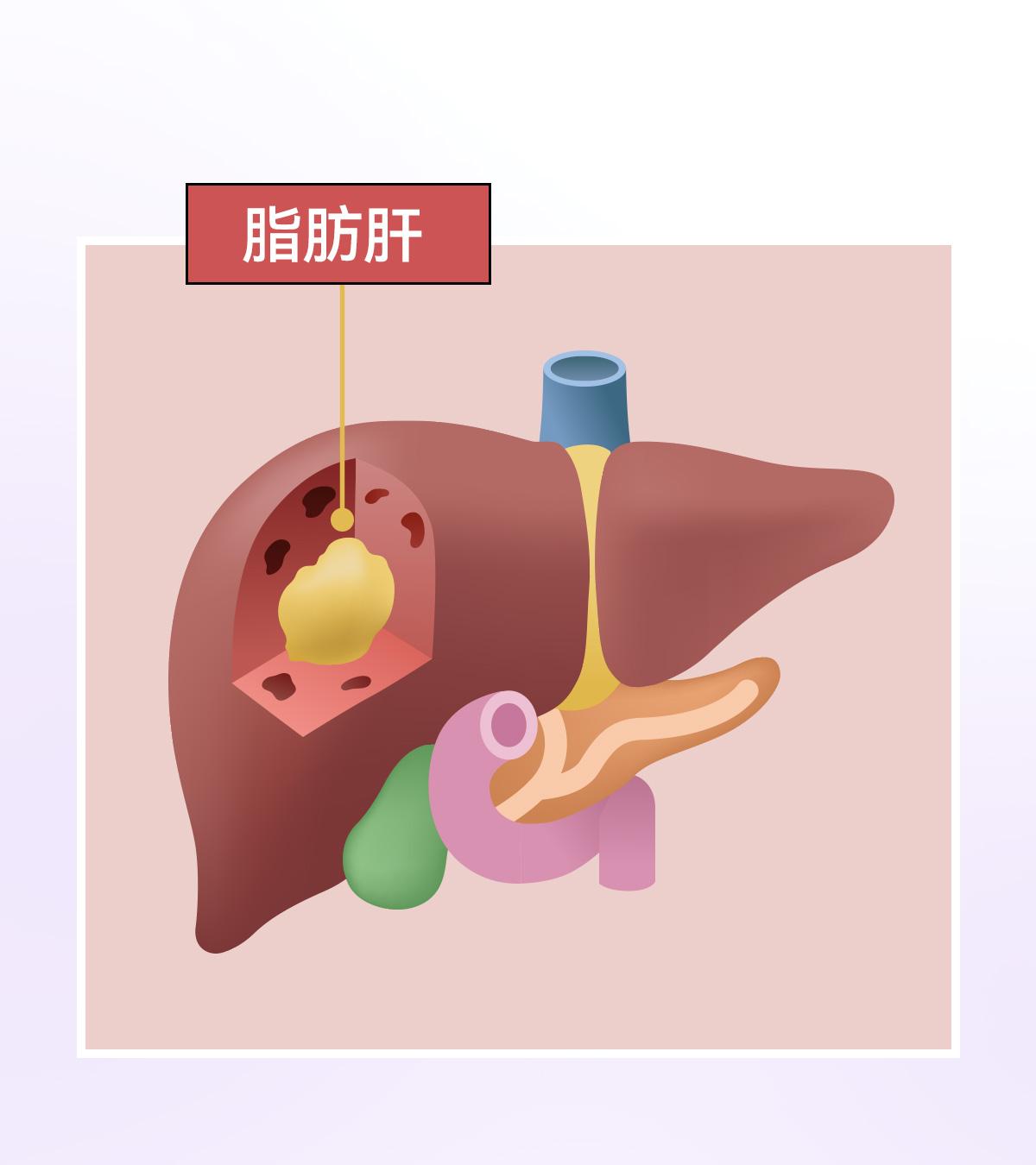 肝病的發展過程為脂肪肝-肝硬化-肝癌!