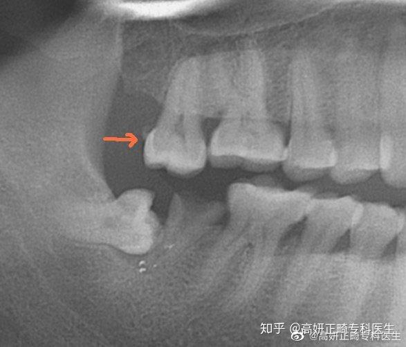 种植前正畸病例一则 知乎