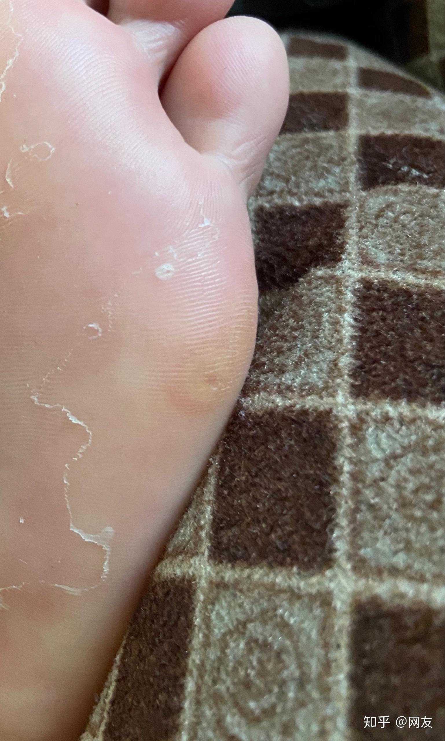 忐忑的问是不是疣,医生说不是,只是皮肤纤维瘤,不用担心,可以做激光扫