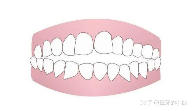 你真的了解牙齿正畸吗？ - 知乎