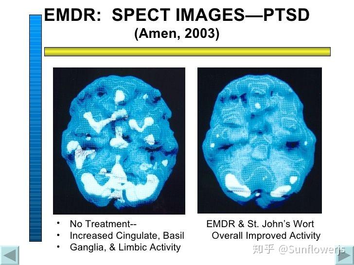 emdr眼动脱敏再处理疗法介绍