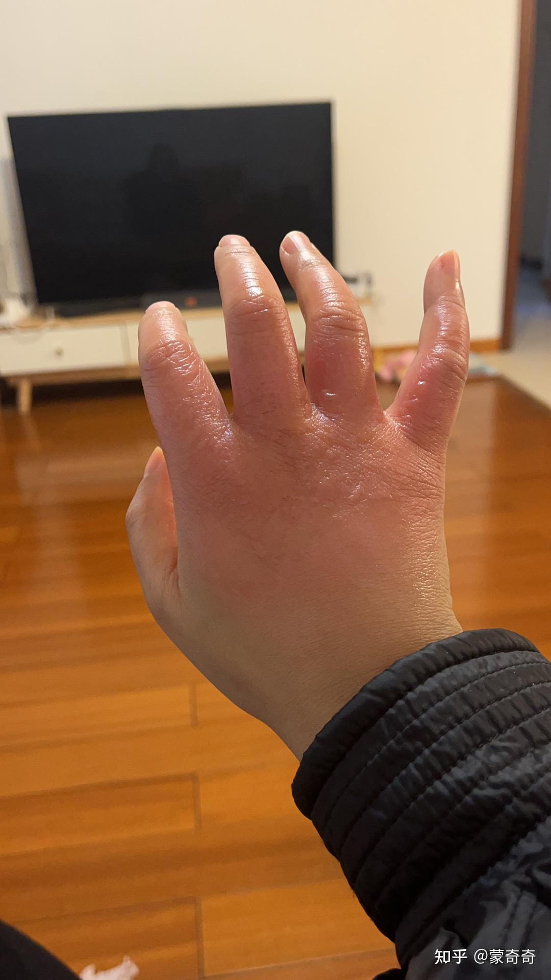 手机充电器烫伤恢复全过程 - 知乎