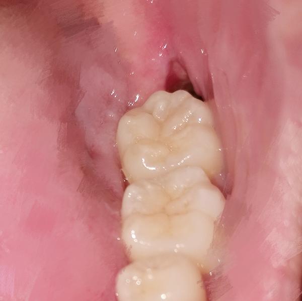 拔完牙后肉里面有大坑食物残渣容易掉进去想知道如何清洁掉