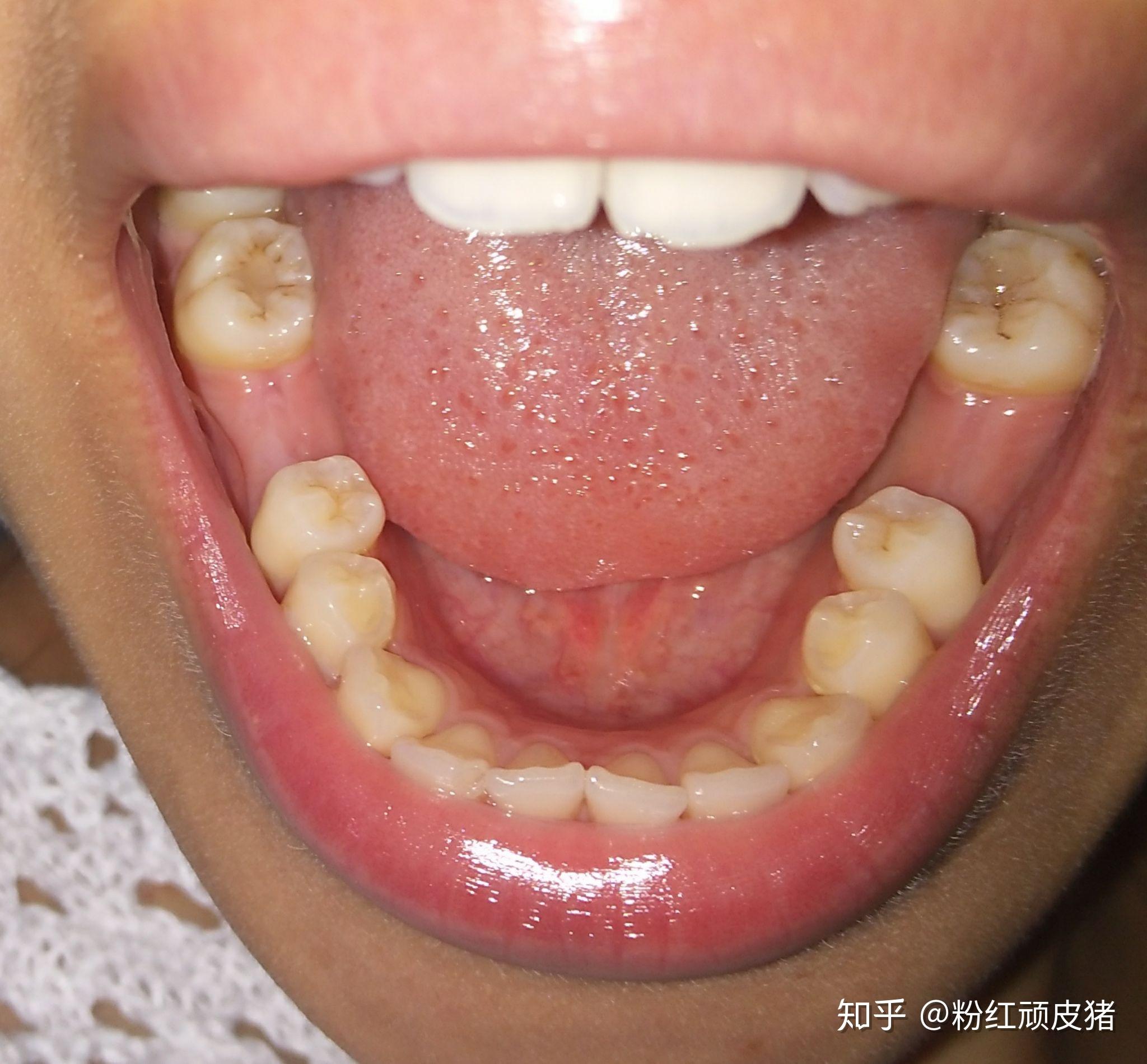 正畸前牙齿情况