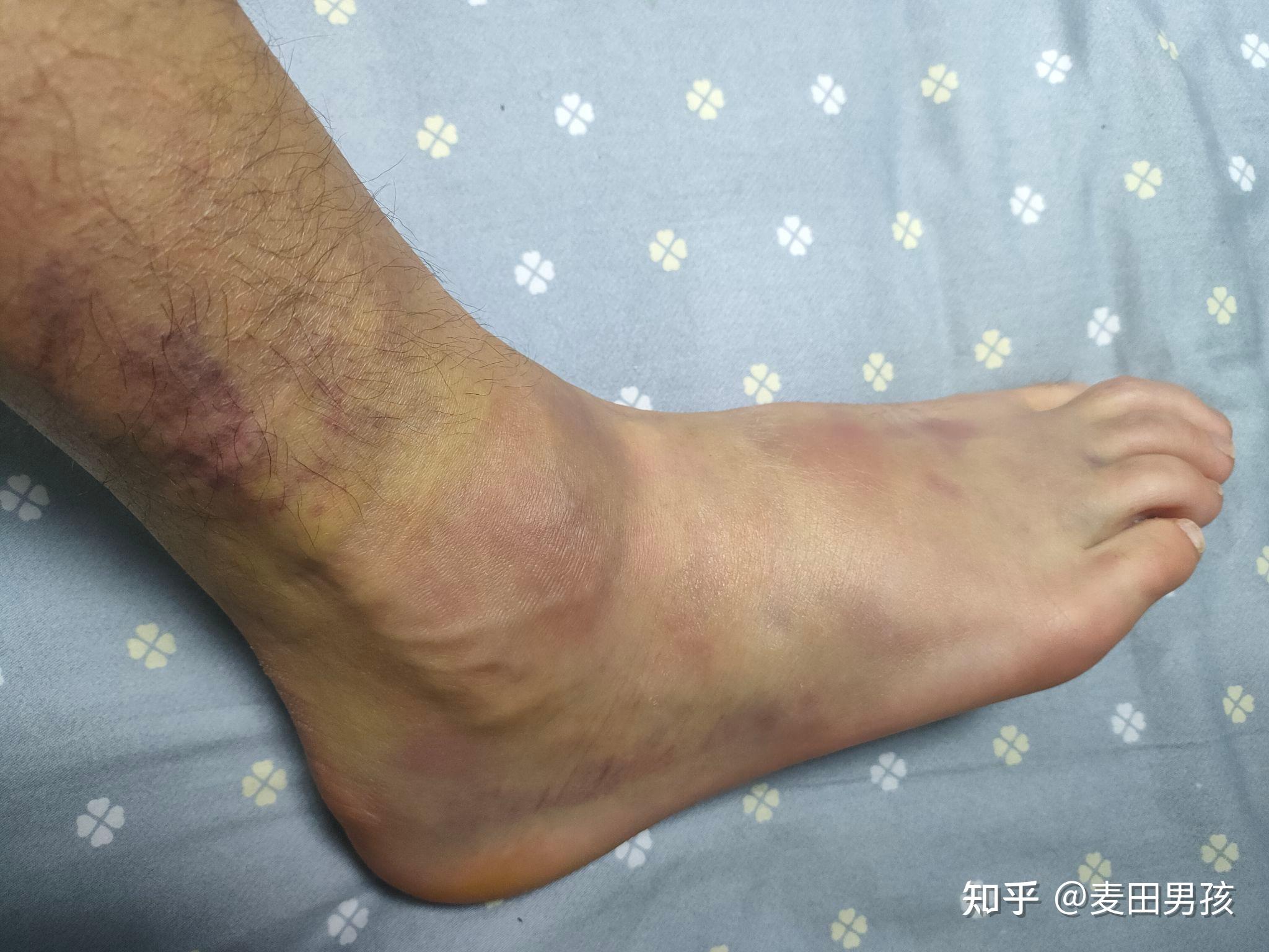患有水肿的病人的腿。照片摄影图片_ID:142043438-Veer图库
