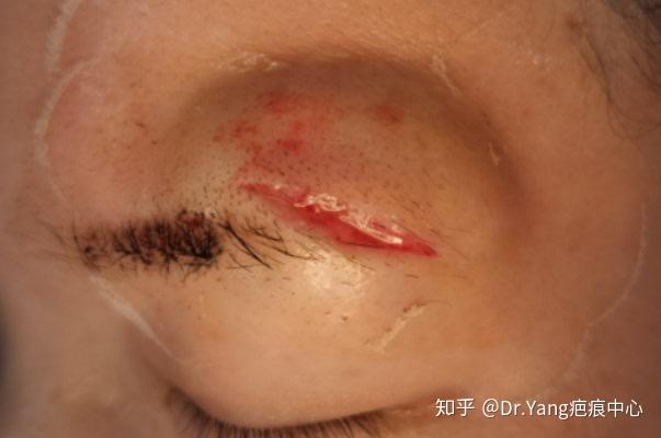 如有条件,颜面外伤最好做美容缝合! - 知乎