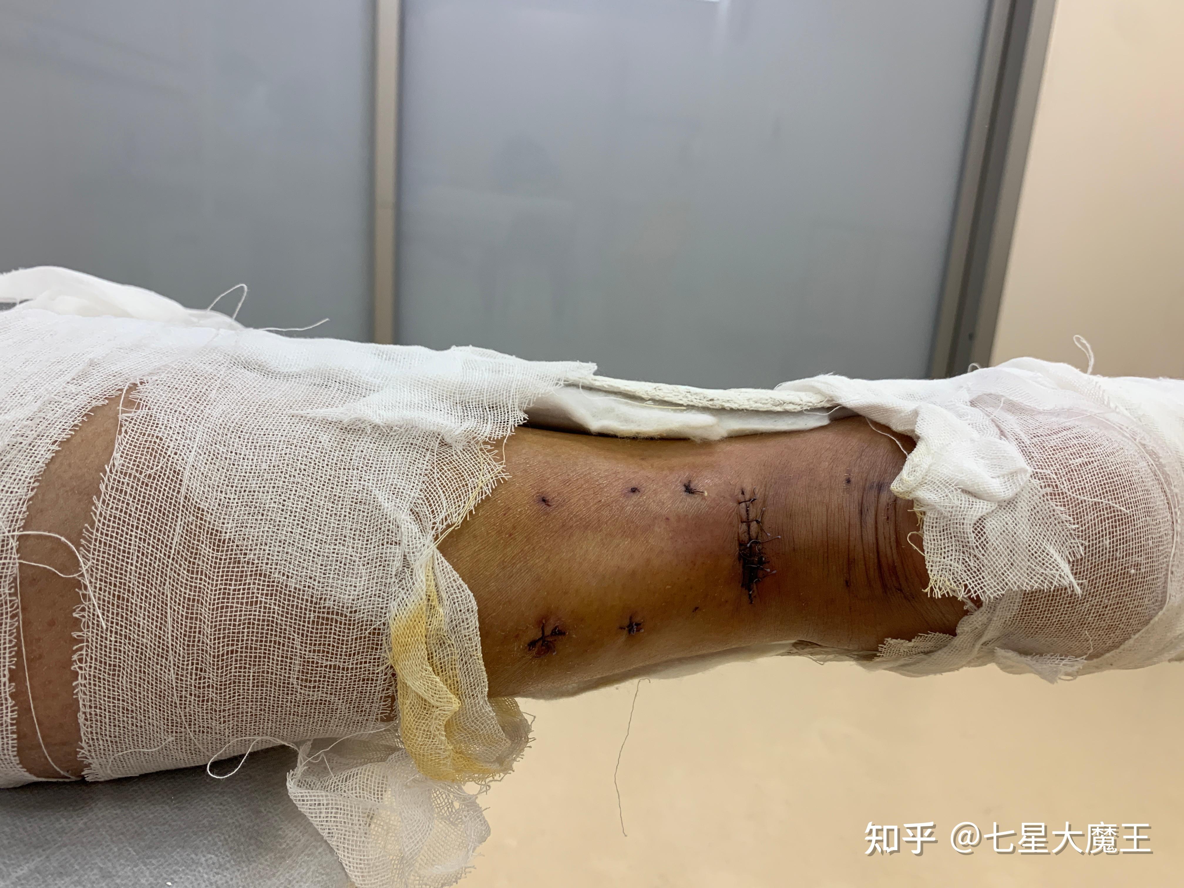 我的跟腱断裂治疗恢复记录