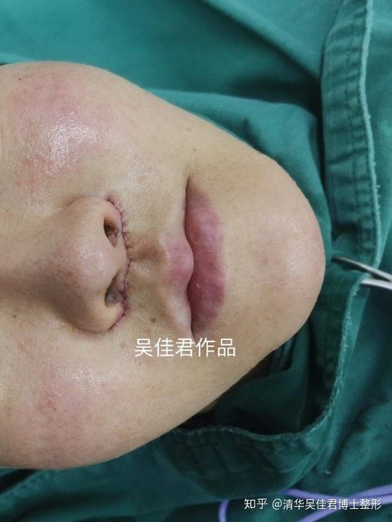 手术顺利,术中轻微出血,经顾客确认后进行缝合,术后即刻能够看出人中