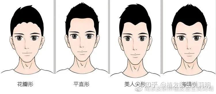 男女发际线种植需看脸定制