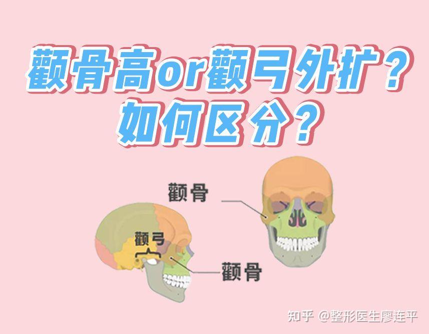 颧骨高/颧弓外扩/假性颧骨高,怎么区分? - 知乎