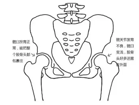 避免宝宝长大后跛行宝爸宝妈记得要做髋关节发育筛查