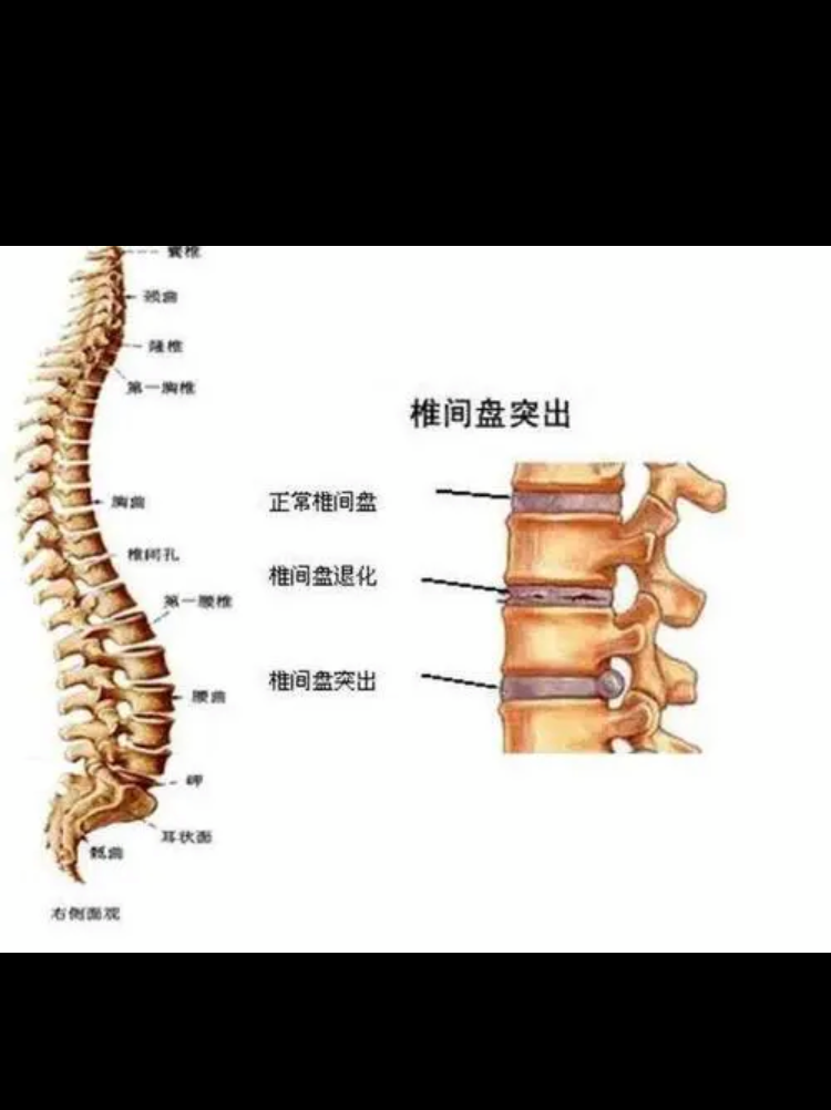 你知道腰椎间盘突出症的康复治疗吗?