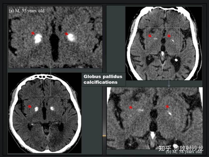 丘脑钙化图片