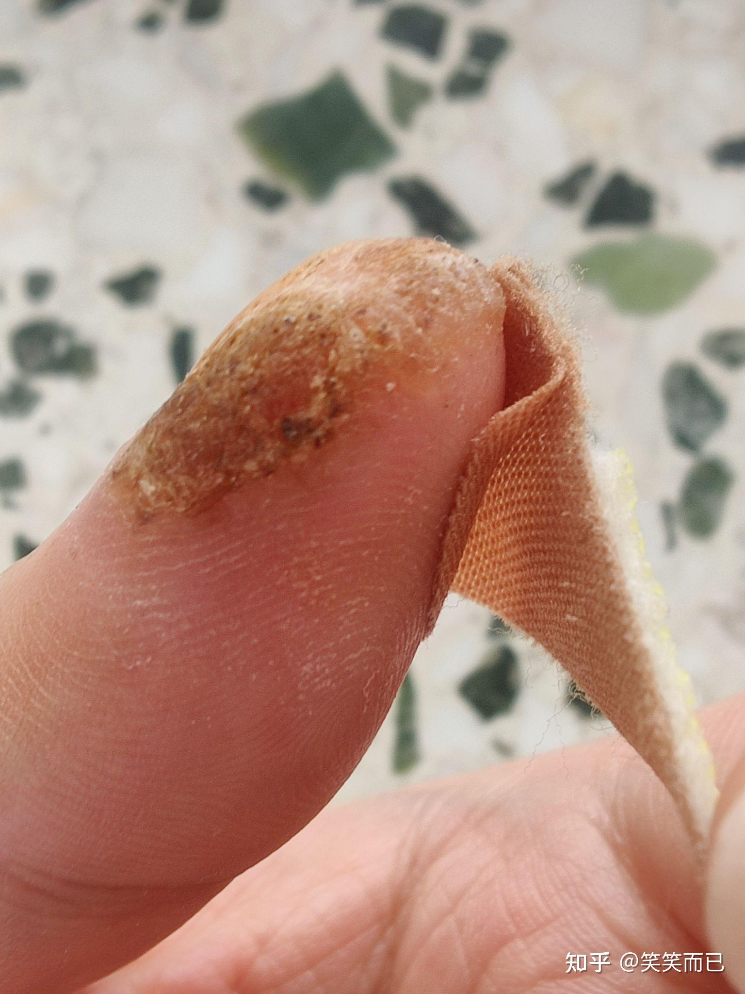 甲周疣自己治疗过程!