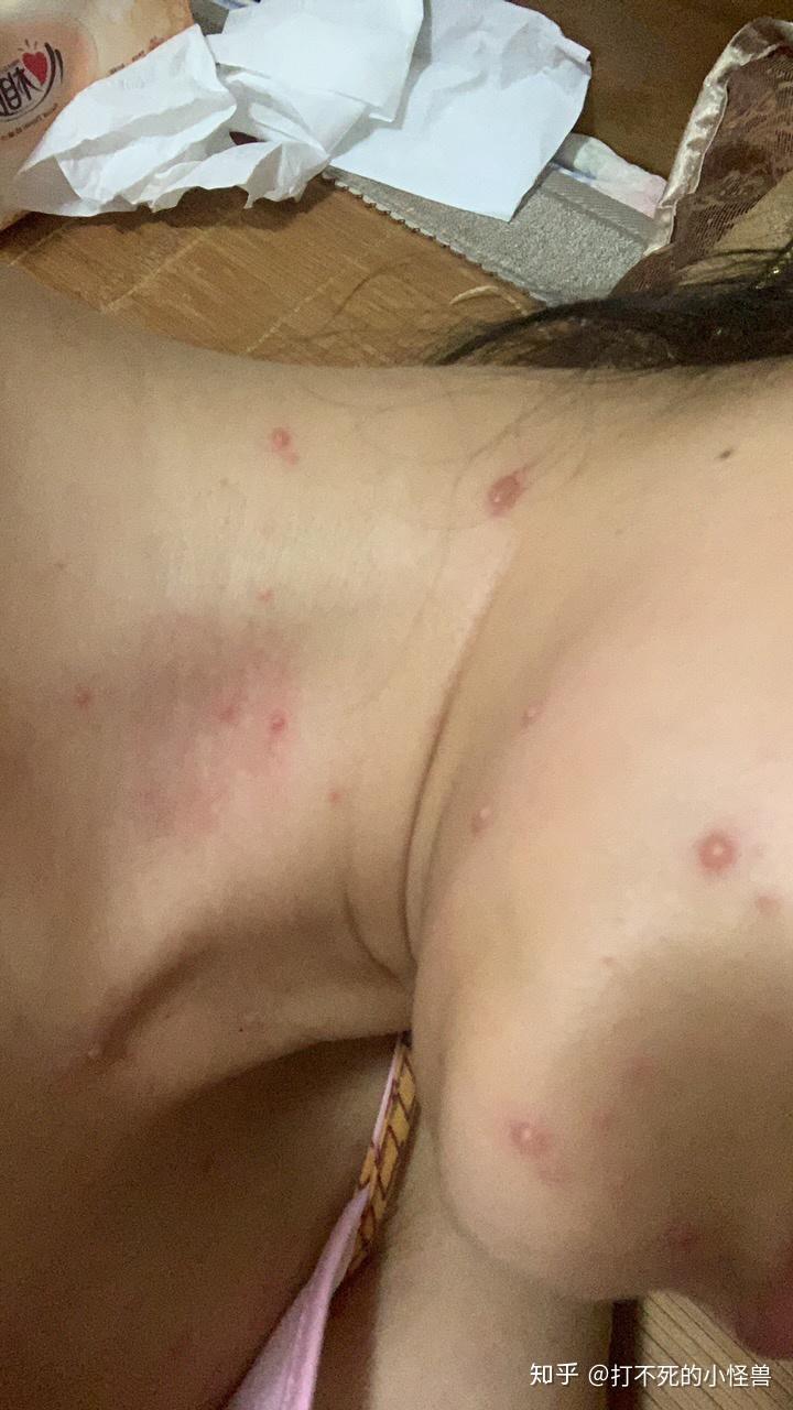 成人水痘 不可忽视的痛 - 知乎