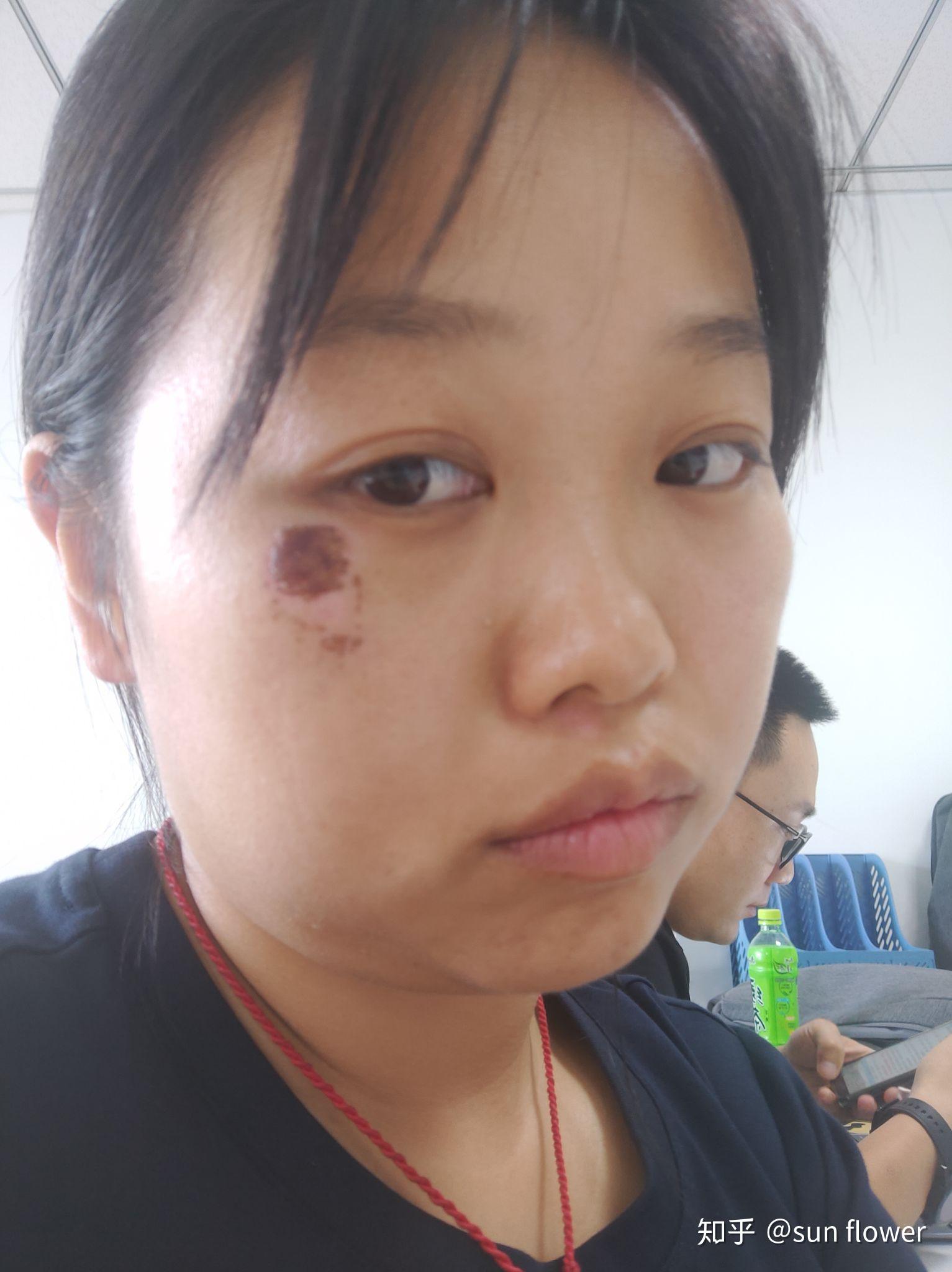 脸摔伤留黑印子色素沉着怎么办