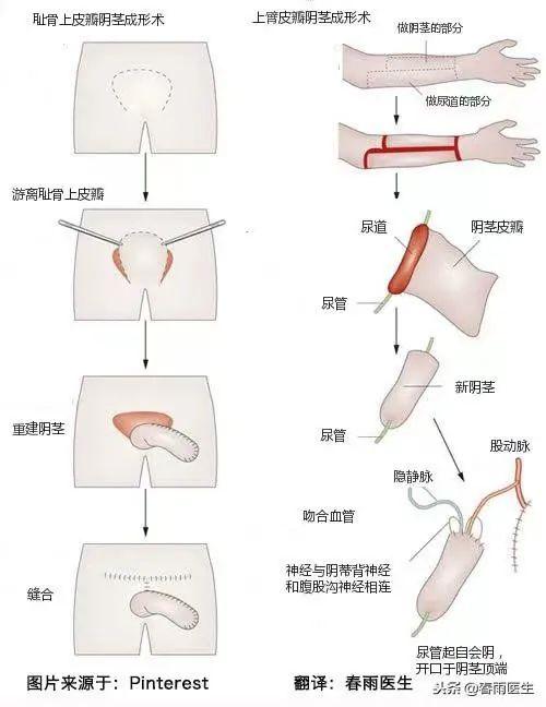 做完变性手术后悔了