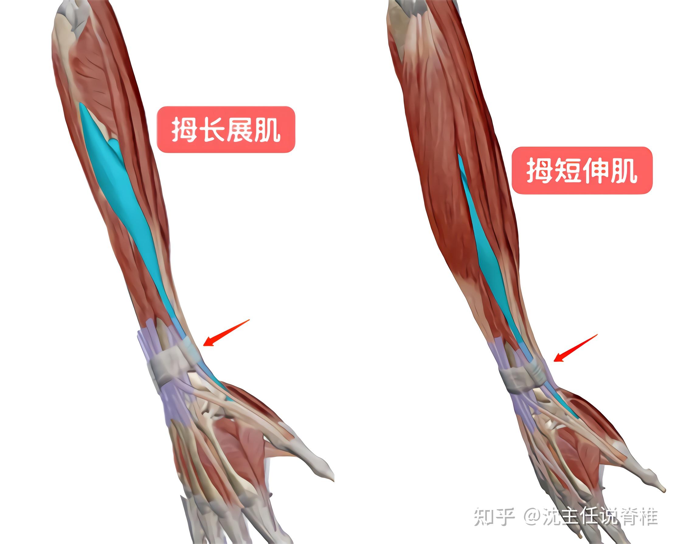 "妈妈手"在医学上学名叫桡骨茎突狭窄性腱鞘炎,主要是由于拇短伸肌和