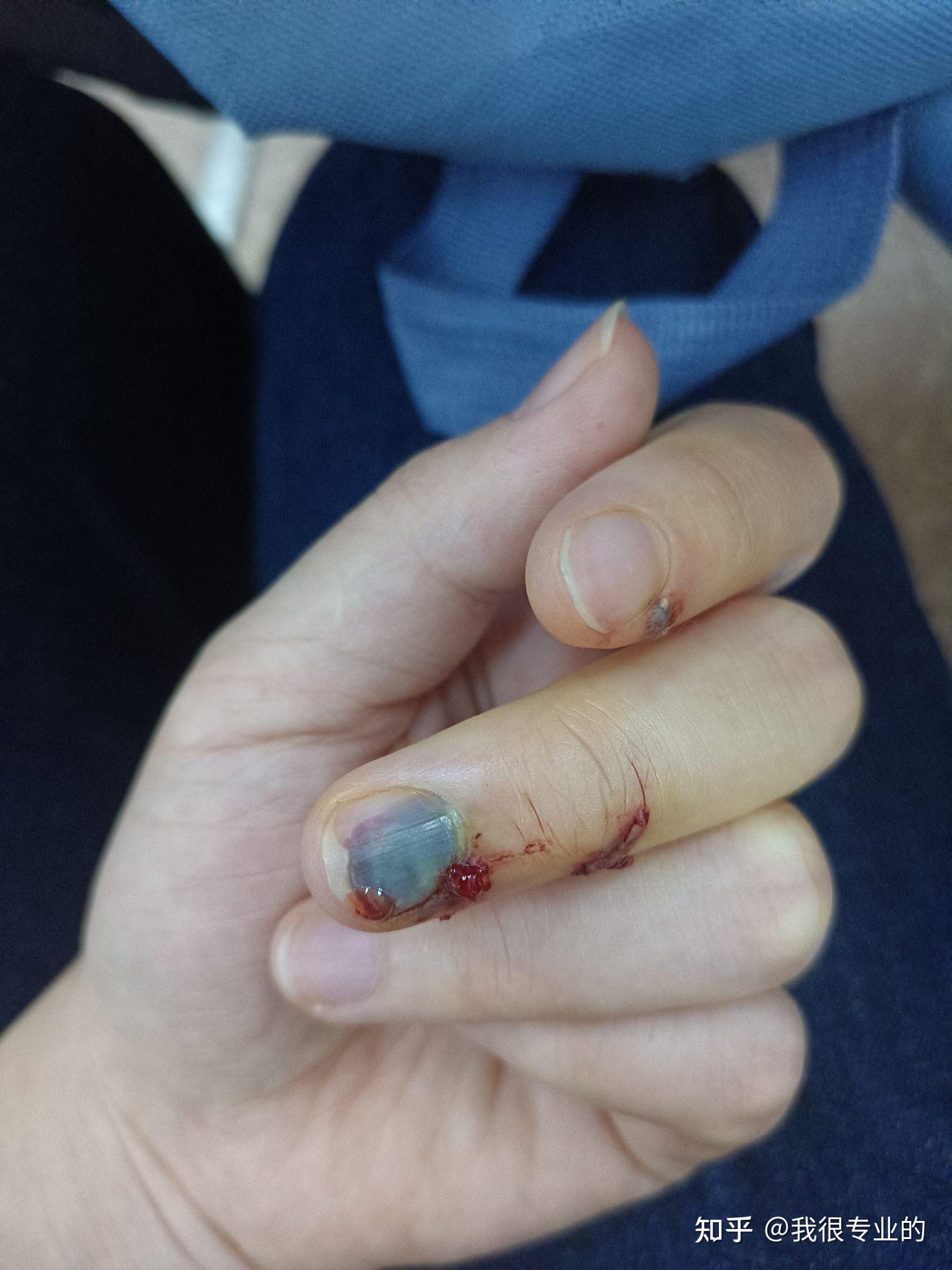 手指甲被风扇打黑了两个星期里面的黑色瘀血能自己出了吗