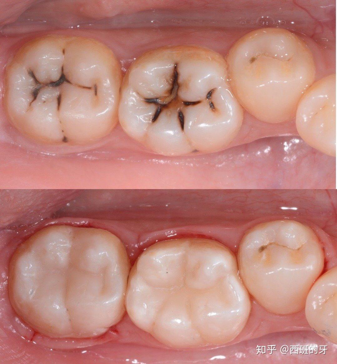 牙齿侧面蛀牙补牙图图片