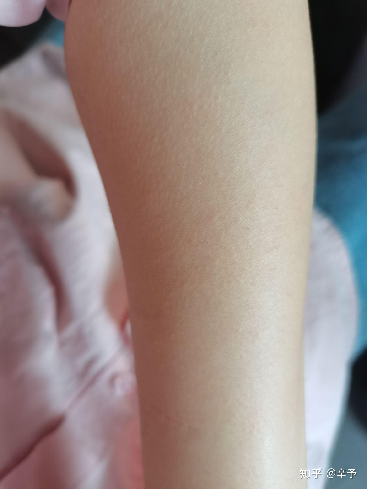 脱毛仪用后变成鸡皮肤(鸡皮肤可以使用脱毛仪吗)