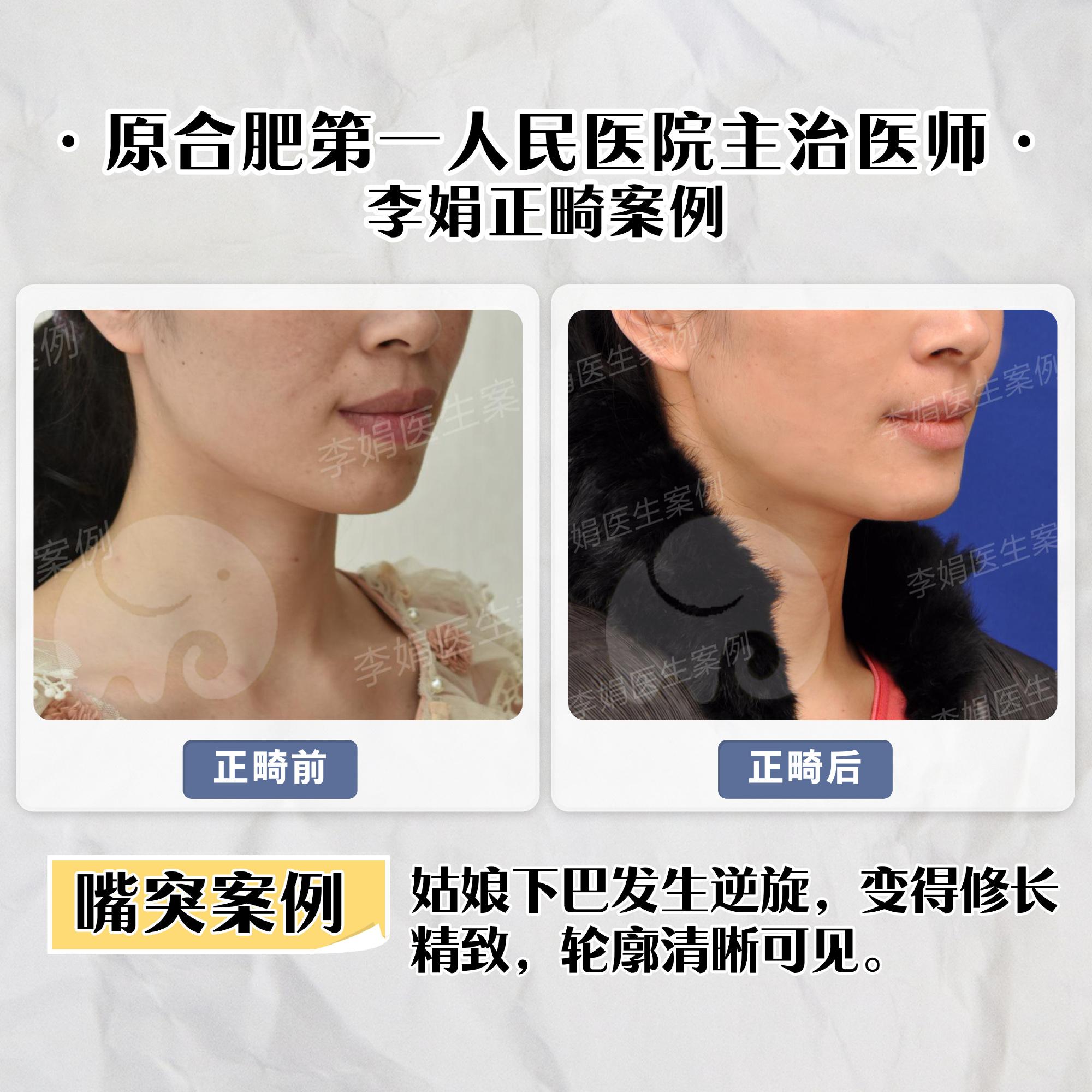 合肥牙齿矫正|第一次牙齿矫正不满意怎么办?李医生告诉你答案 - 知乎