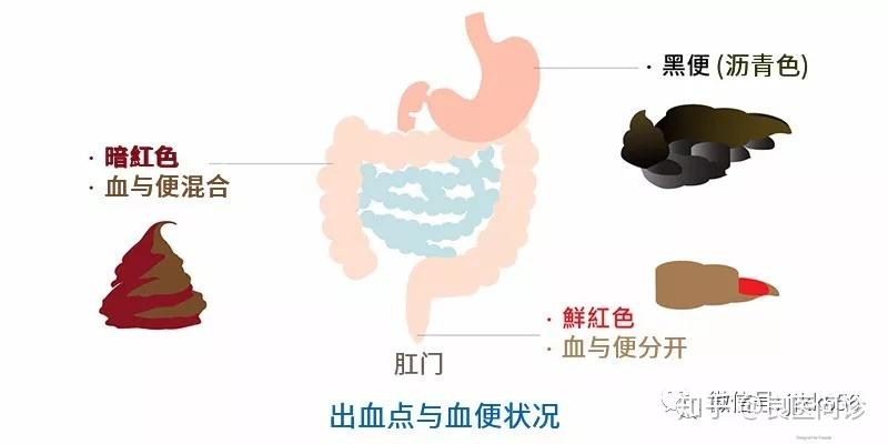 血便可能是黑色、暗红、鲜红,出血点不同则原因不同! - 知乎